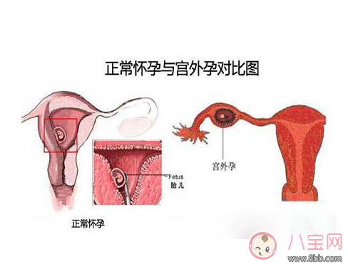 導致宮外孕危害相當大 生活中這樣做可以預防