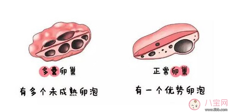 昆凌三胎計(jì)劃，昆凌多囊性卵巢癥候群是什么病