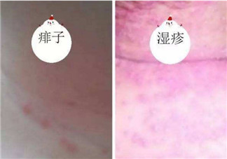 寶寶痱子和濕疹的區別 寶寶濕疹和痱子最大的不同是什么