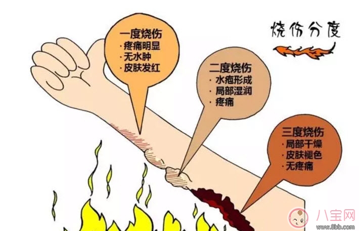 寶寶燙傷怎么辦 寶寶燙傷急救處理方法