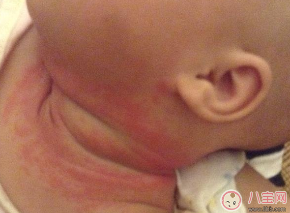 夏天寶寶脖子被淹和起痱子的區別在哪里(圖文)