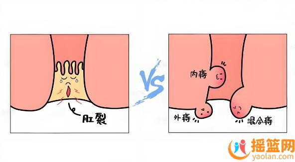 如何在不影響寶寶哺乳的情況下，解決媽媽的肛裂痔瘡問題？