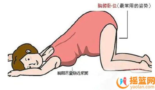 胎位不正：分娩前這樣糾正，避免難產風險
