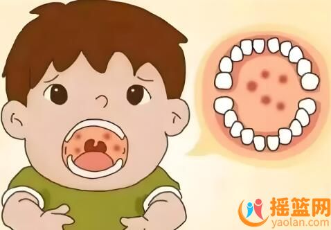皰疹性咽峽炎高發(fā)季，家長如何做好科學(xué)防護？